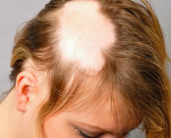 alopecia